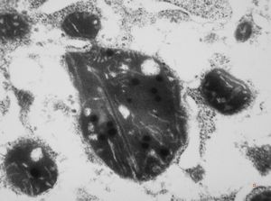 F,14y. | megamitochondria - Wilson disease F,14y. | megamitochondria - Wilson disease